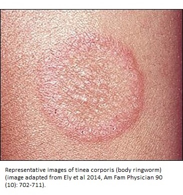 Tinea Corporis (Body Ringworm) - Dermatologic Disorders - Merck Manuals  Professional Edition