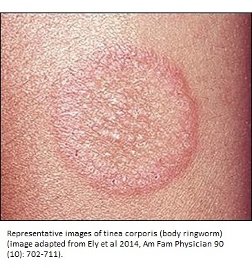 Tinea - The Cause of Most Fungal Skin Infections